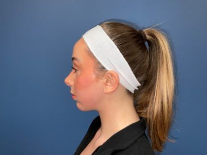 Rhinoplasty Before & After