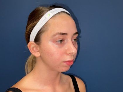 Rhinoplasty Before & After