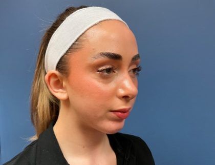 Rhinoplasty Before & After