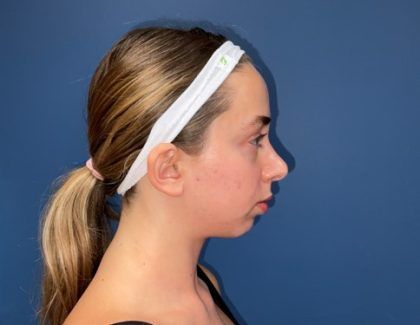 Rhinoplasty Before & After