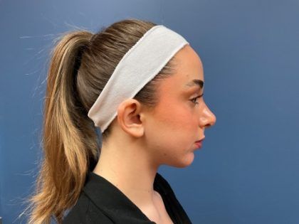 Rhinoplasty Before & After