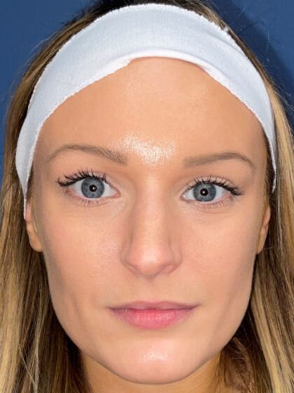 Rhinoplasty Before & After