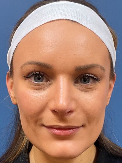 Rhinoplasty Before & After