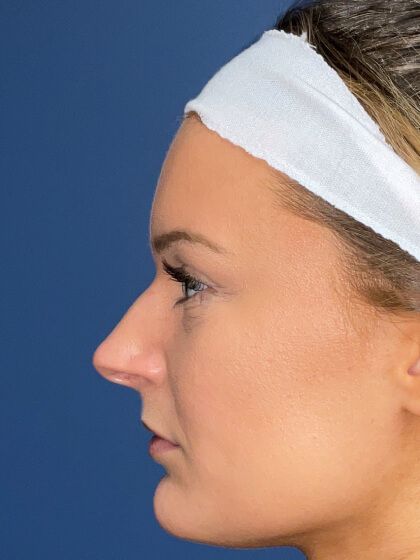 Rhinoplasty Before & After