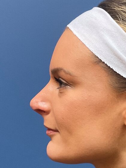 Rhinoplasty Before & After