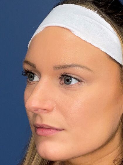 Rhinoplasty Before & After