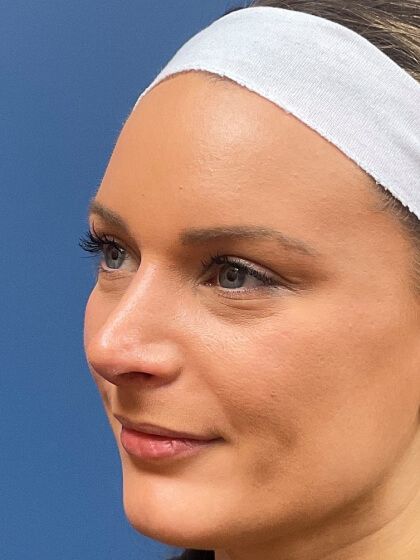 Rhinoplasty Before & After