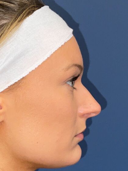 Rhinoplasty Before & After