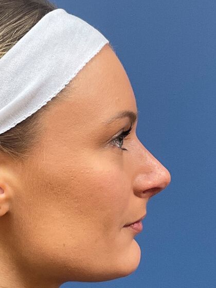 Rhinoplasty Before & After