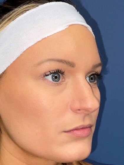 Rhinoplasty Before & After
