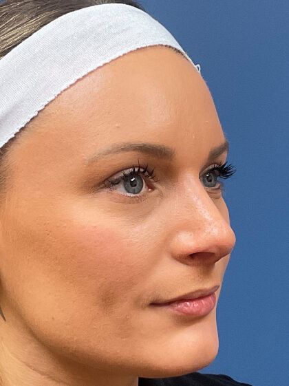 Rhinoplasty Before & After