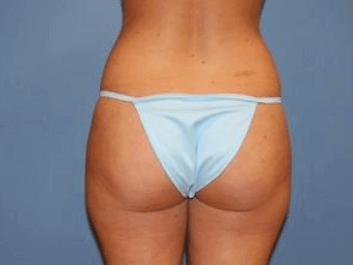 Liposuction Before & After