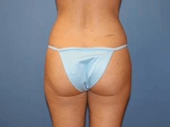 Liposuction Before & After