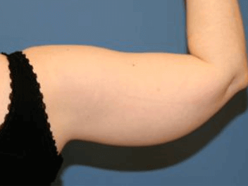 Liposuction Before & After