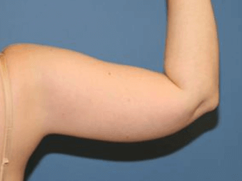 Liposuction Before & After