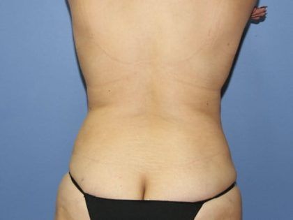 Liposuction Before & After