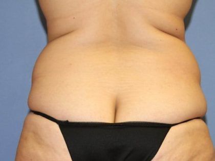Liposuction Before & After