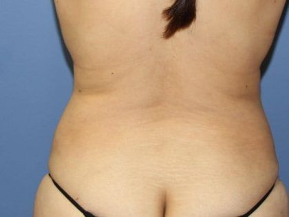 Liposuction Before & After