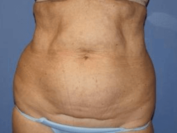 Liposuction Before & After