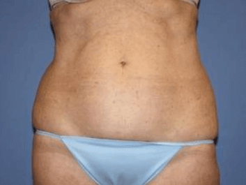 Liposuction Before & After
