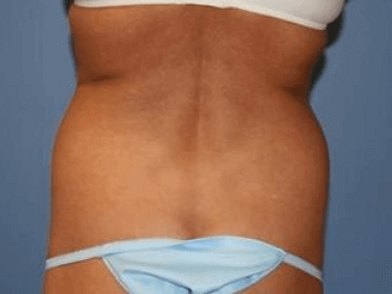 Liposuction Before & After