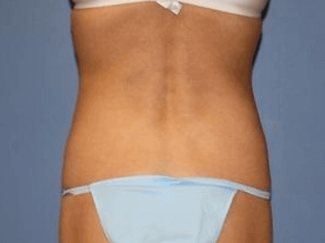 Liposuction Before & After
