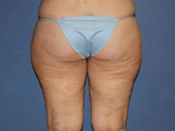 Liposuction Before & After