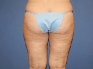 Liposuction Before & After