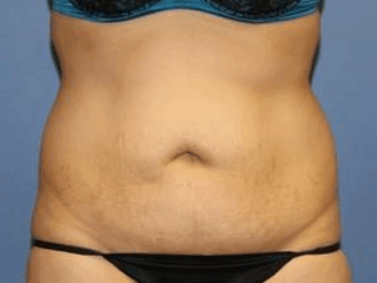 Liposuction Before & After