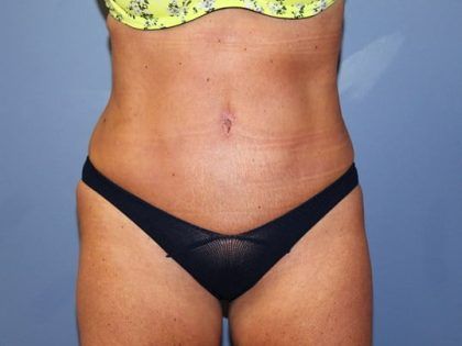 Liposuction Before & After