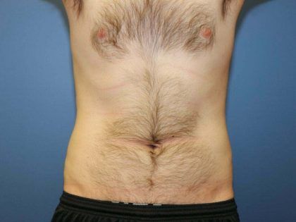 Liposuction Before & After