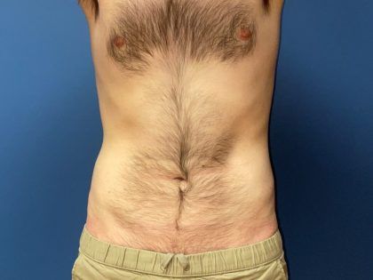 Liposuction Before & After