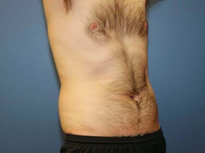 Liposuction Before & After