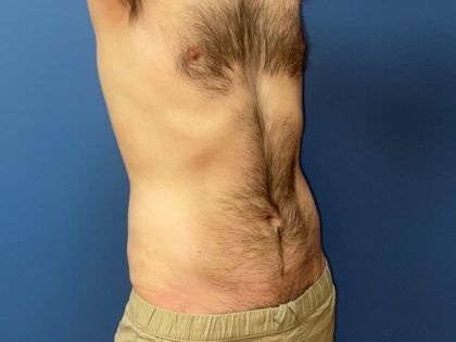 Liposuction Before & After