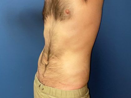 Liposuction Before & After