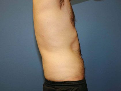 Liposuction Before & After