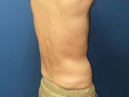 Liposuction Before & After