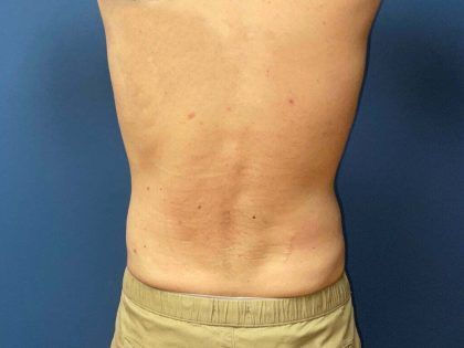 Liposuction Before & After