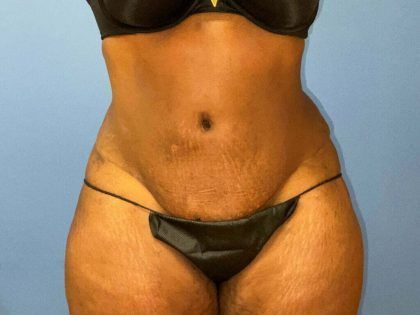 Liposuction Before & After