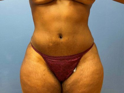 Liposuction Before & After