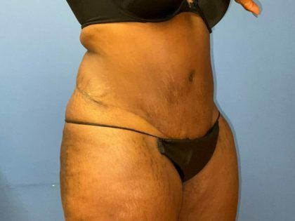 Liposuction Before & After