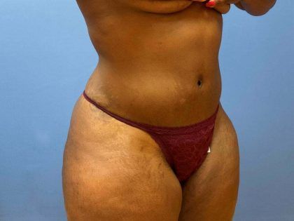 Liposuction Before & After