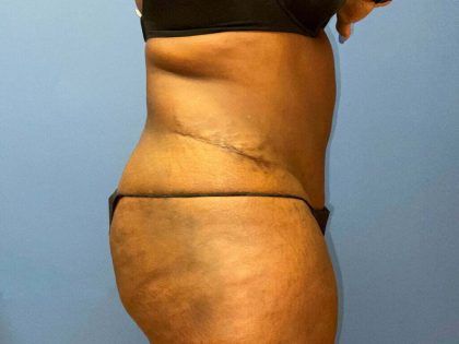 Liposuction Before & After