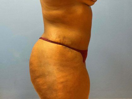 Liposuction Before & After