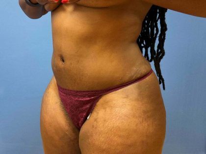 Liposuction Before & After