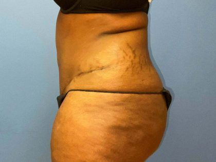 Liposuction Before & After