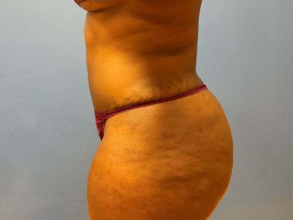 Liposuction Before & After