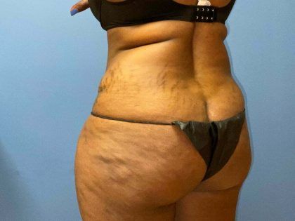 Liposuction Before & After