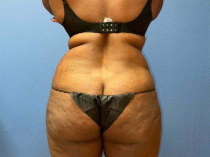 Liposuction Before & After