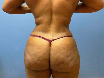 Liposuction Before & After